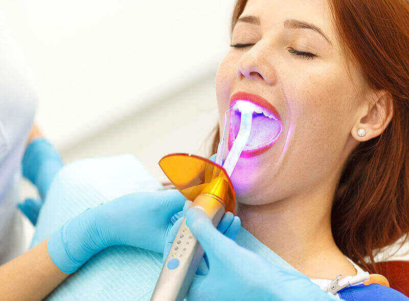 Dental Bonding Ottawa