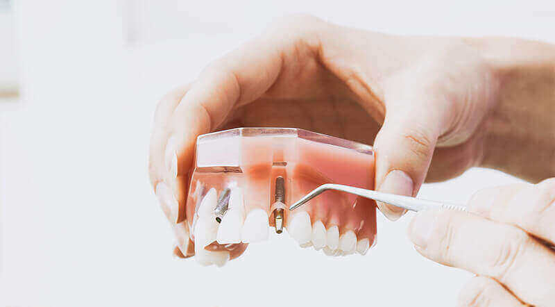 Dental Implants Ottawa