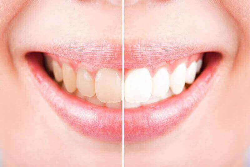 Whitening for Life Ottawa