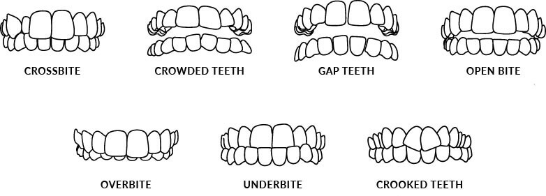 Invisalign Treatable cases